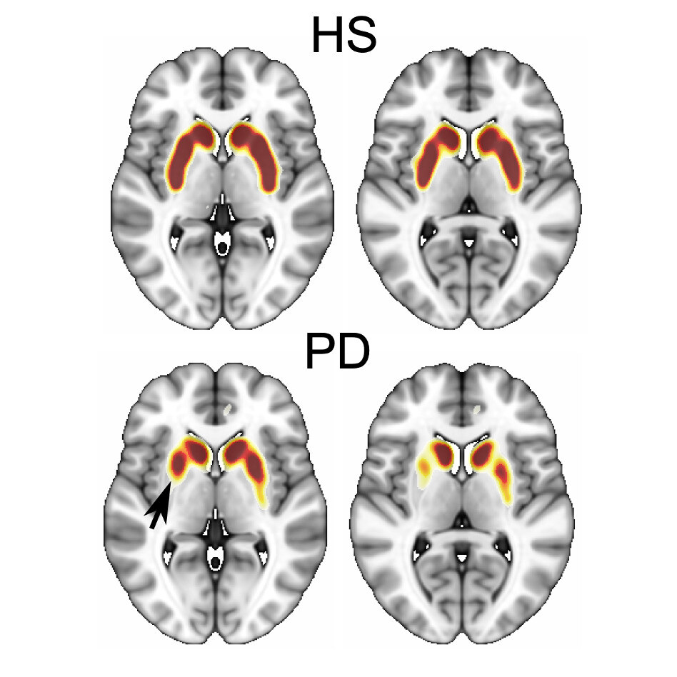 Neuroimaging figure
